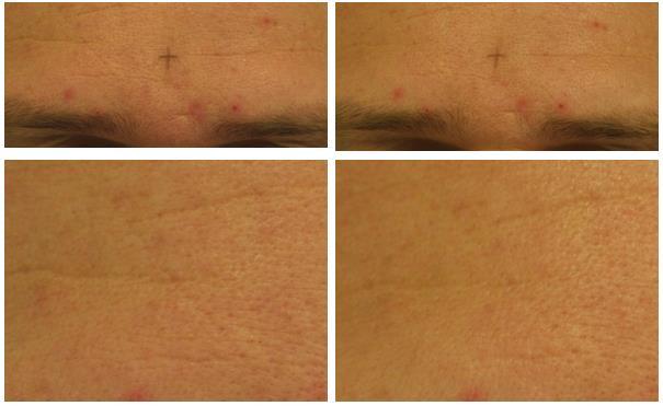 To further demonstrate the observed effects an O/W cream containing 5% HyaCare Filler CL was applied on the face. The following pictures show furrows before and after the application (Figures 11, 12).
