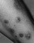 Mycobacterium abscessus Infections Santiago, Chile July to December, 2002 51 cases of infection from 5