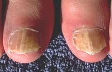 Diabetes, circulation problems or a weakened immune system Diagnosis If all nails are affected then fungal infection is improbable.