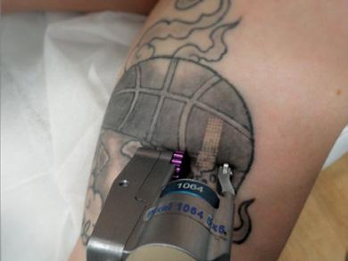 The mechanical Q-Switched effect works by vibrating and breaking down the ink particles in the tattoo.