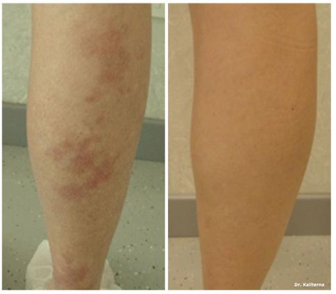 Deep leg veins are most effectively treated using the long-pulsed Nd:YAG laser.