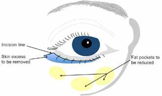 What types of lower blepharoplasty are there? Lower blepharoplasty can address the fat that bulges in the lower lids as well as the loose skin.