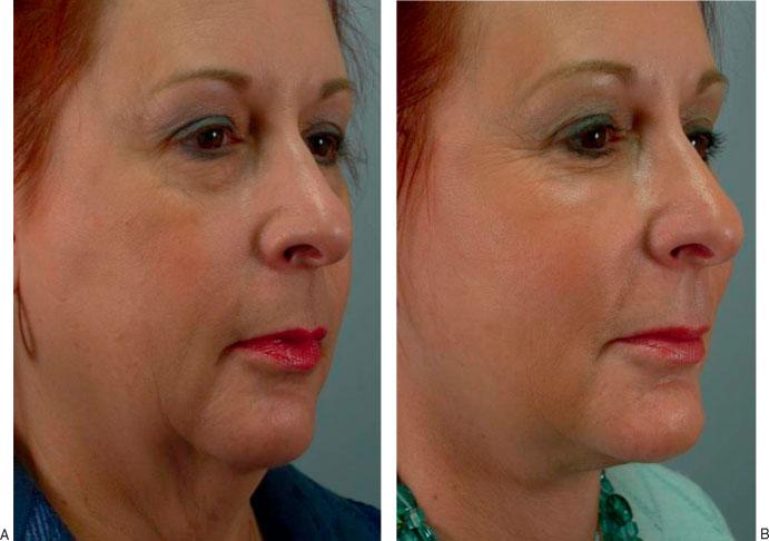 FAT MANAGEMENT IN LOWER LID BLEPHAROPLASTY/YEH, WILLIAMS 243 Figure 15 (A) Preoperative oblique photograph of a woman with significant periorbital