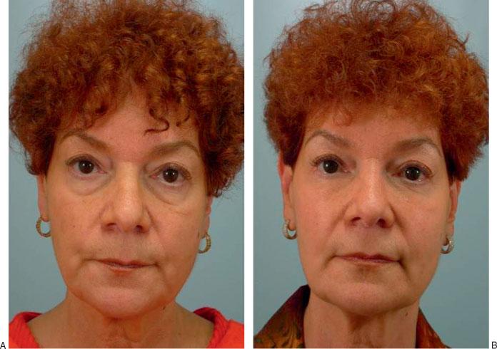 (B) Postoperative photograph at 1 year after lipotransfer to the lower eyelid demonstrates restoration of a youthful lower eyelid contour.