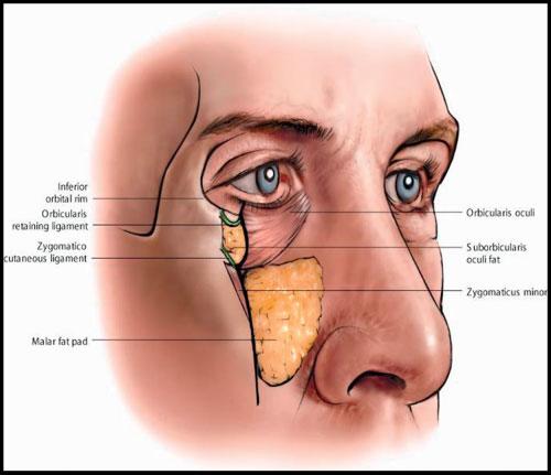FAT MANAGEMENT IN LOWER LID BLEPHAROPLASTY/YEH, WILLIAMS 235 Figure 1 Anatomic changes in the aged lower lid include a weakened orbital septum, laxity of the orbicularis retaining ligament and