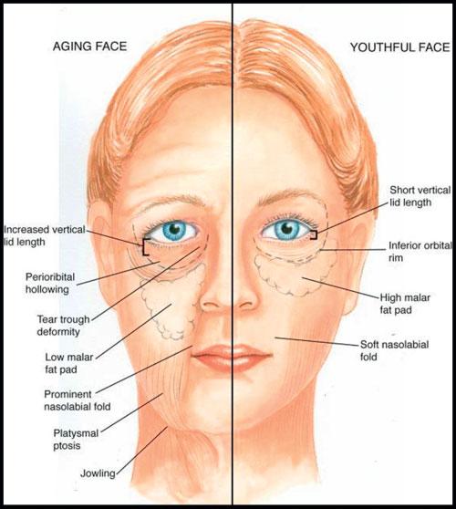 236 FACIAL PLASTIC SURGERY/VOLUME 25, NUMBER 4 2009 Figure 2 Comparison of the cumulative effects of aging on the lower lid and midface complex.