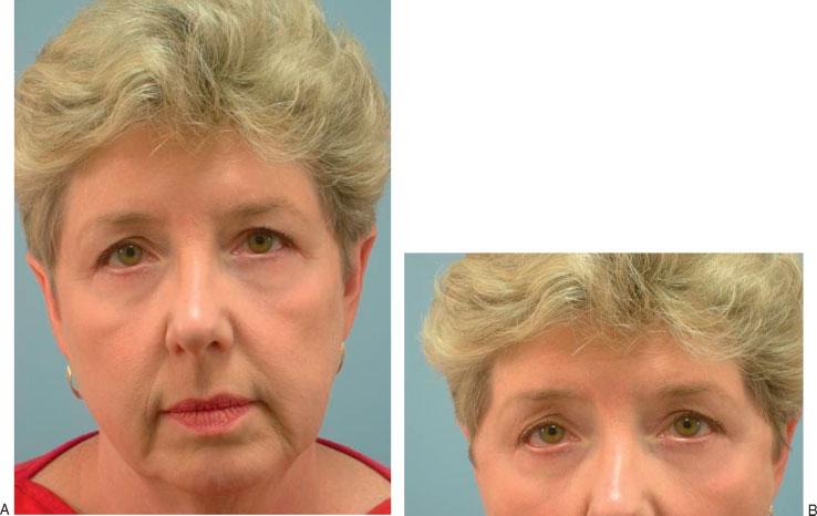 FAT MANAGEMENT IN LOWER LID BLEPHAROPLASTY/YEH, WILLIAMS 237 Figure 4 (A) A woman 2 months after a skin-muscle flap