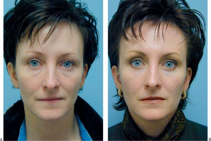 238 FACIAL PLASTIC SURGERY/VOLUME 25, NUMBER 4 2009 Figure 6 (A) Preoperative photograph of a woman who