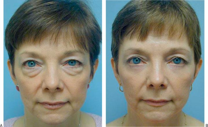 (B) Postoperative photograph at 1 year after transconjunctival blepharoplasty.