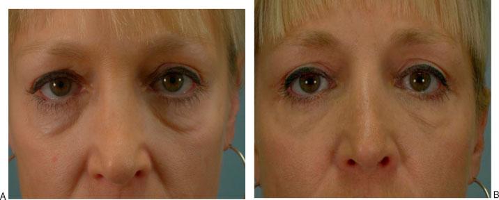 Results of lower eyelid rejuvenation from an isolated transconjunctival blepharoplasty approach certainly reveal an aesthetic improvement of the lower lid.