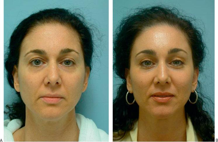 (B) Postoperative photograph at 1 year after transconjunctival blepharoplasty shows improvement after reduction of pseudoherniated fat but demonstrates a suboptimal