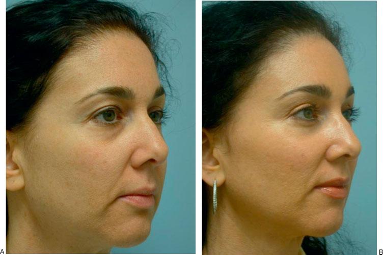 FAT MANAGEMENT IN LOWER LID BLEPHAROPLASTY/YEH, WILLIAMS 241 Figure 12 (A) Preoperative oblique photograph of the same woman in Fig. 11A.