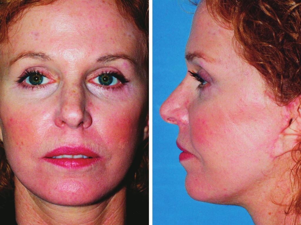 Examination and comparison of her preoperative and postoperative photographs before and after the first face lift indicate that there was relatively little change in the appearance of the midface