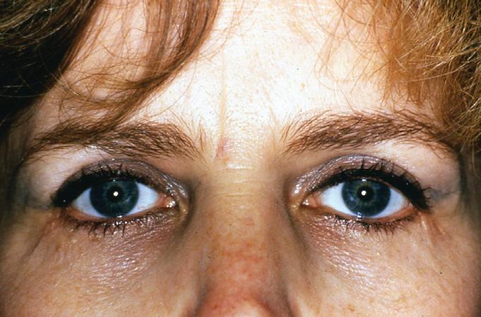 Figure 2. A, Whites typically have lower eyebrows., Asians typically have higher eyebrows. Subbrow Sub-brow blepharoplasties Other blepharoplasties Figure 3.