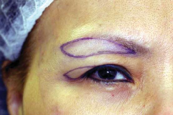 Figure 5. A, The skin has been marked for subbrow blepharoplasty., The marked skin is pinched to simulate the postoperative results. A Figure 6.