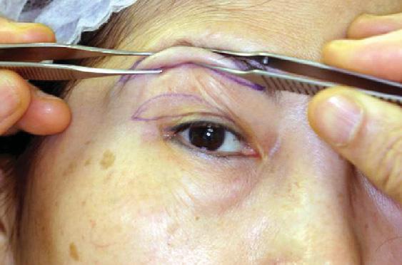 COMPLICATIONS The specific possible complications of S include scarring of the upper eyelids, damage to the supraorbital neurovascular bundles, asymmetry of the eyebrows and supratarsal folds, and