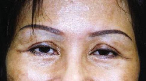 C, Preoperative view of a 52- year-old woman who had extended lateral scars on the upper eyelids