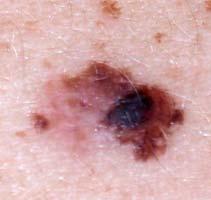 on any moles and any changes or unusual skin growths.