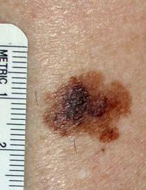 There are certain things to look out for with moles using the ABCD guide: Asymmetry when