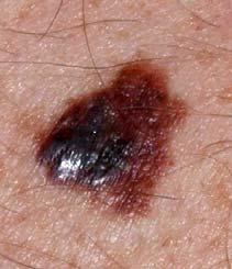 ragged / irregular Colour when the colour of the mole varies throughout Diameter if the