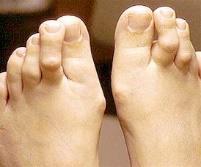arthritis, and previous injury to the toe. People with diabetes should contact their doctor at the first sight of hammertoes, as it can become a serious problem due to poor circulation.
