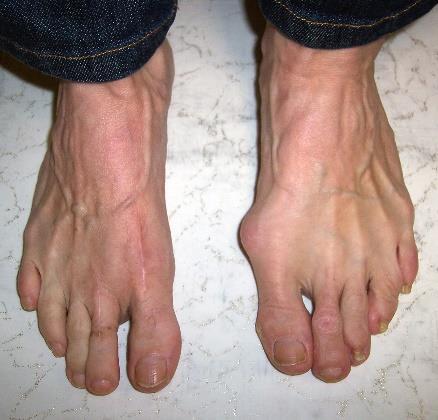 The signs & symptoms of corns are: Dry, waxy, transparent and/or horny buildup of skin on the feet Could be hard or soft to touch Painful to touch Bunions A bunion is a deformed big toe that usually