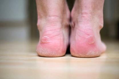 Cracking and/or peeling of the skin between the toes or on the soles of the feet Blisters on the feet that itch Dry skin on the soles and/or sides of the feet Raw skin on the feet Thick, discolored