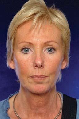A B Figure 12. A, C, E, G, Preoperative views of a 52-year-old woman who had an upper blepharoplasty 5 years ago.