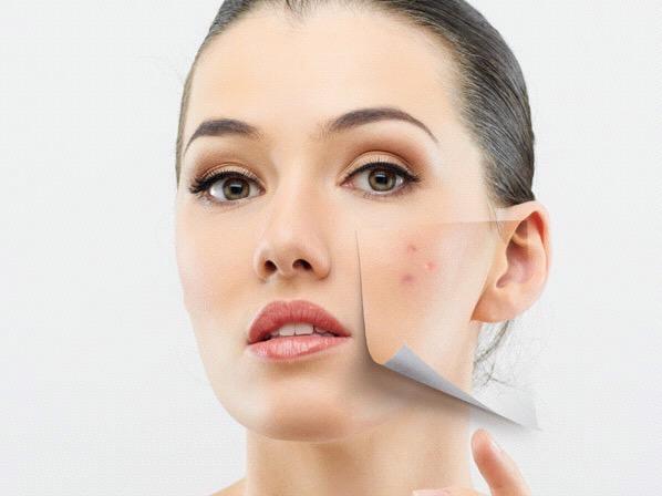 COMMON SKIN PROBLEMS ACNE: The sebaceous glands are to be blamed if you have acne.