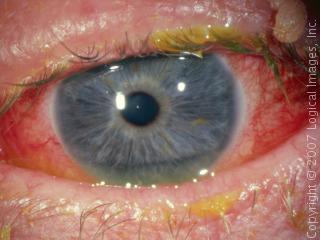conjunctiva due to chemicals with neutral ph (ph=7) Solvents