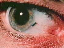 Foreign Body Conjunctival Usually Not Imbedded Flush eye or swab to remove Under lids can be tough to find and get out Usually no antibiotics First Aid Care?
