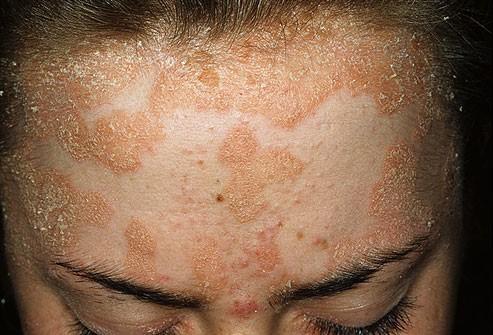 14 What causes acne? Rising hrmne levels during puberty may cause acne. In additin, acne is ften inherited.