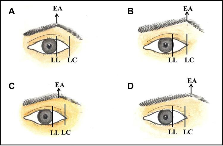 980 Aesthetic Surgery Journal 33(7) Figure 8. Types of eyebrow apex position.