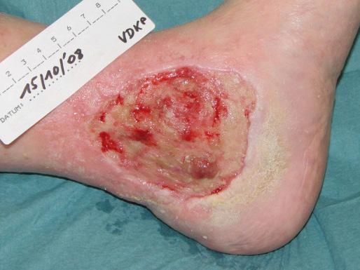 chronic and acute wounds 16 such as skin tears,