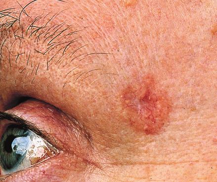 Common types of skin cancer: Basal cell carcinoma Squamous cell carcinoma Less common but more dangerous forms of skin cancer: Nodular melanoma Photos: SunSmart (Cancer Council Victoria) Sun