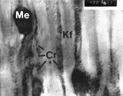 850 JOURNAL OF FORENSIC SCIENCES seen crowded between the thick filament bundles in the keratinizing hair cortex cell (Fig. 6). The dead cortical cells retain a membranous nuclear outline (i.e., nuclear ghost) that persists into the hair shaft.