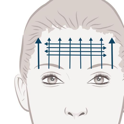 6.4 Female, Age 40 Forehead smoothing,