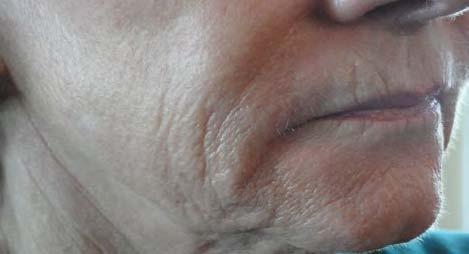 (right) treatment with retinol (1%) for 12