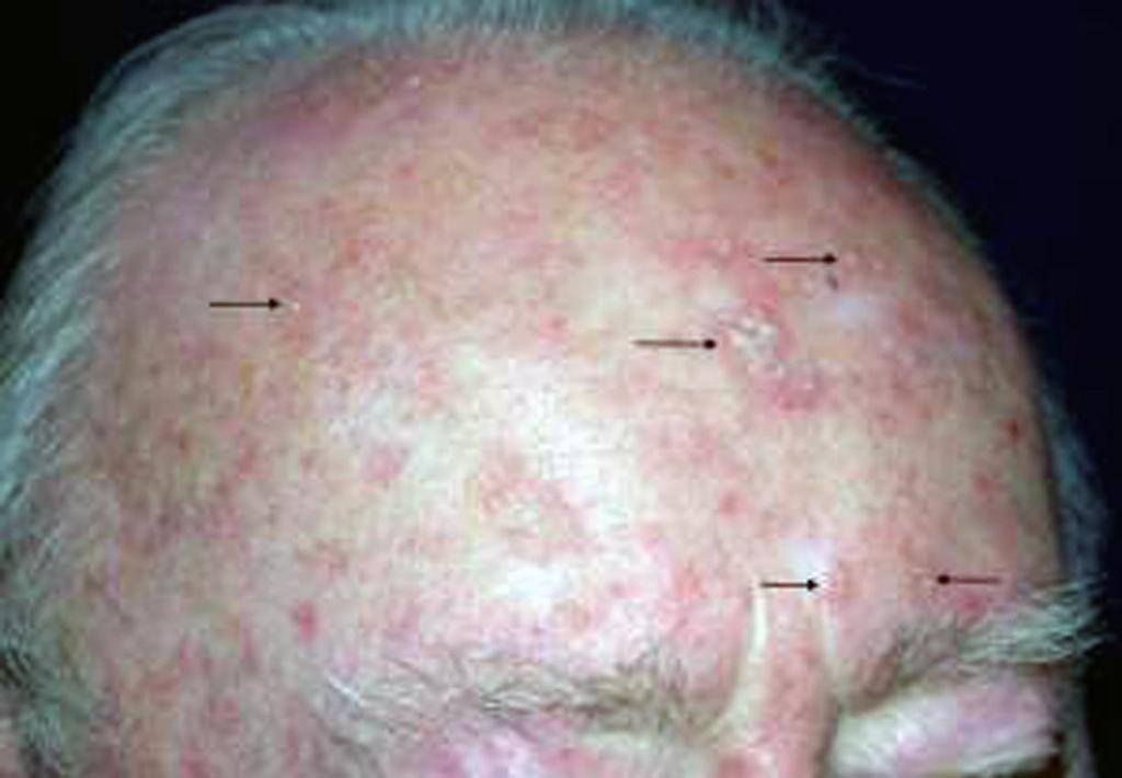 Actinic Keratoses Presents most commonly on backs of