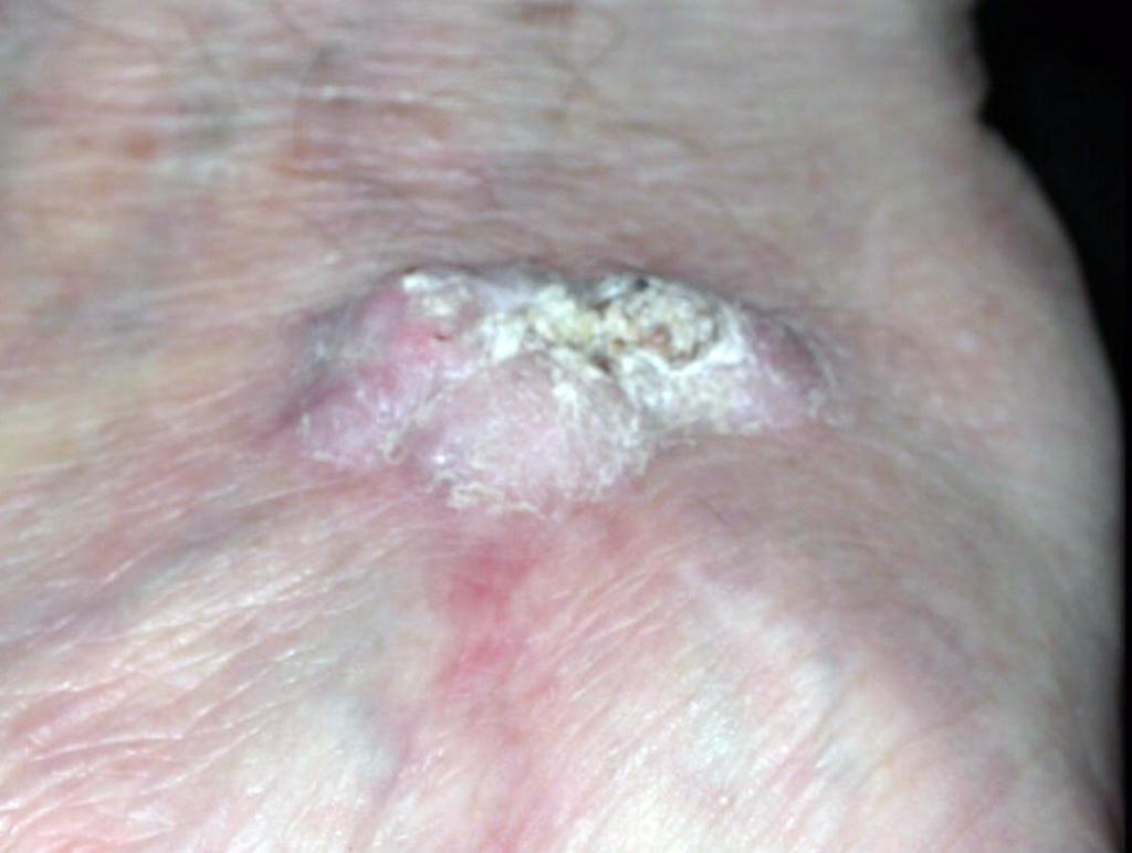 Squamous Cell Carcinoma (SCC) May grow rapidly, forming a tender crusting lump Found on