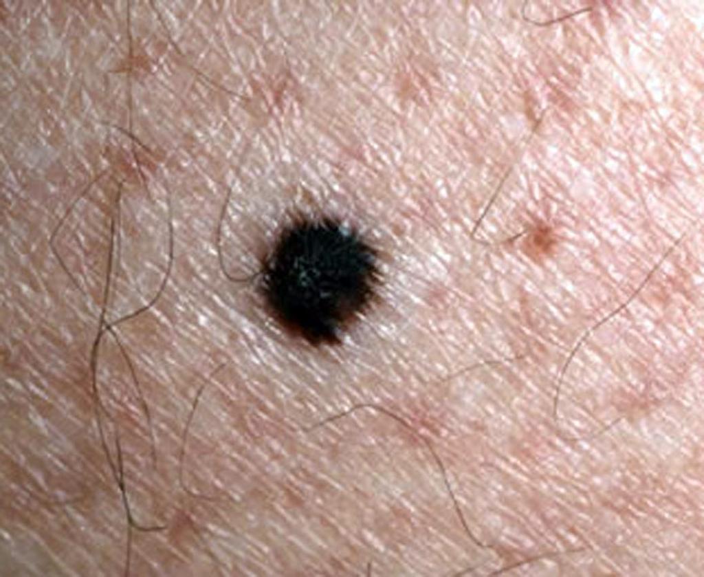 Malignant Melanoma (MM) Least common skin cancer but the most dangerous.