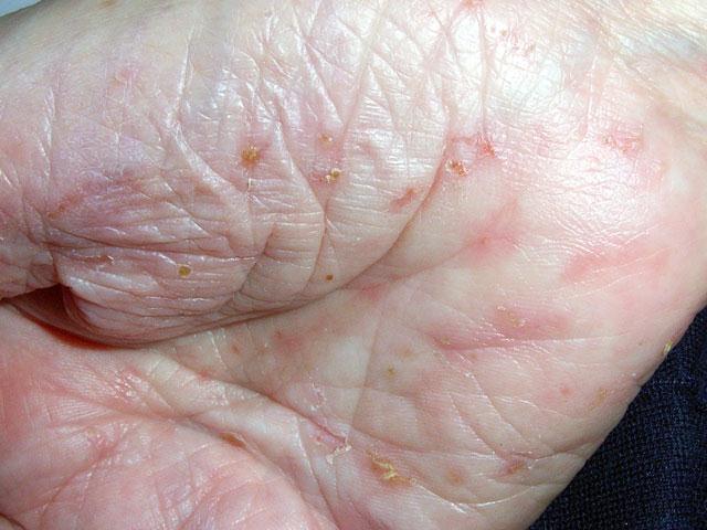 are typical of scabies in a staff member