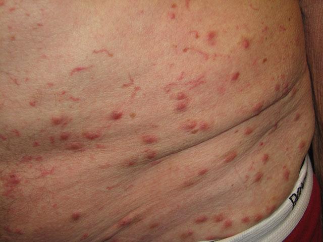 Nodular Scabies Complicated (Infected) Scabies Fig