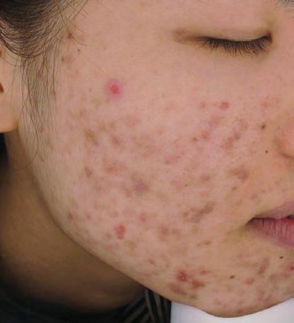 Laser Genesis TM & Skin rejuvenation for a wide variety of skin conditions Acne Vulgaris: Burton Scale Grade 4 Skin type IV, Japanese, 20-year-old, Female Patient History - Patient had been suffering