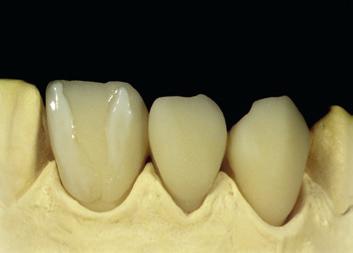 After prepolishing with a ceramic polisher the finished crowns & bridges are sand-blasted with 50 microns Al0 2 at 1.5 bar pressure.