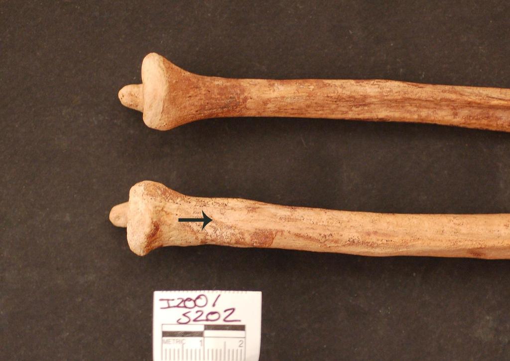 Figure 11: Individual 200 055 Healed fracture of the distal right ulna The other adult individuals analyzed this season show similar patterns of trauma and pathology.