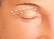 Step 2 The incision The incision lines for eyelid surgery are designed so the resultant scars will be well concealed within the natural structures of