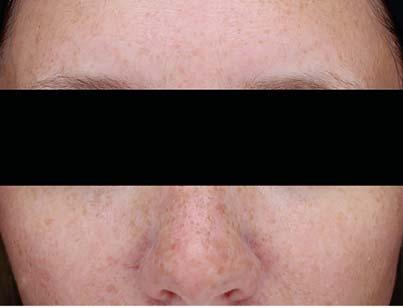 LaseMD Non-Ablative 1927 nm Fractional Thulium Laser Treatments RESURFACING FOR ALL PATIENTS LaseMD treatments