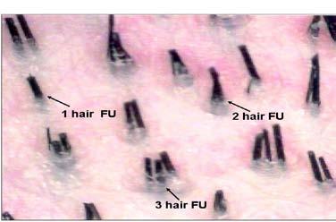 6 Follicular Unit density on the scalp is currently felt to average between 75 to100 FU/cm2 although it may range higher or lower.