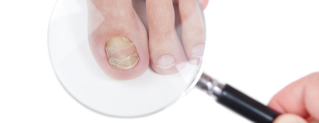Background: Causes and Symptoms Of Fungal Toenails Fungal nails, known medically as onychomycosis, are caused by a group of fungi known as dermatophytes.